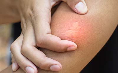 Bee Sting vs Wasp Sting in Atlanta GA - Active Pest Control