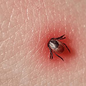 Tick-Borne Diseases in Georgia in your area