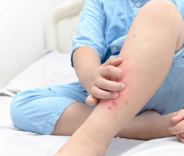 Learn how to identify bed bug bites - Active Pest Control