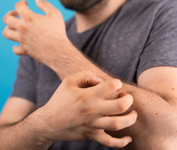 Learn if bed bug bites itch  - Active Pest Control