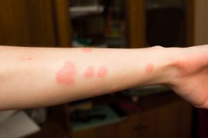Hand with bites from fleas in Georgia; Active Pest Control
