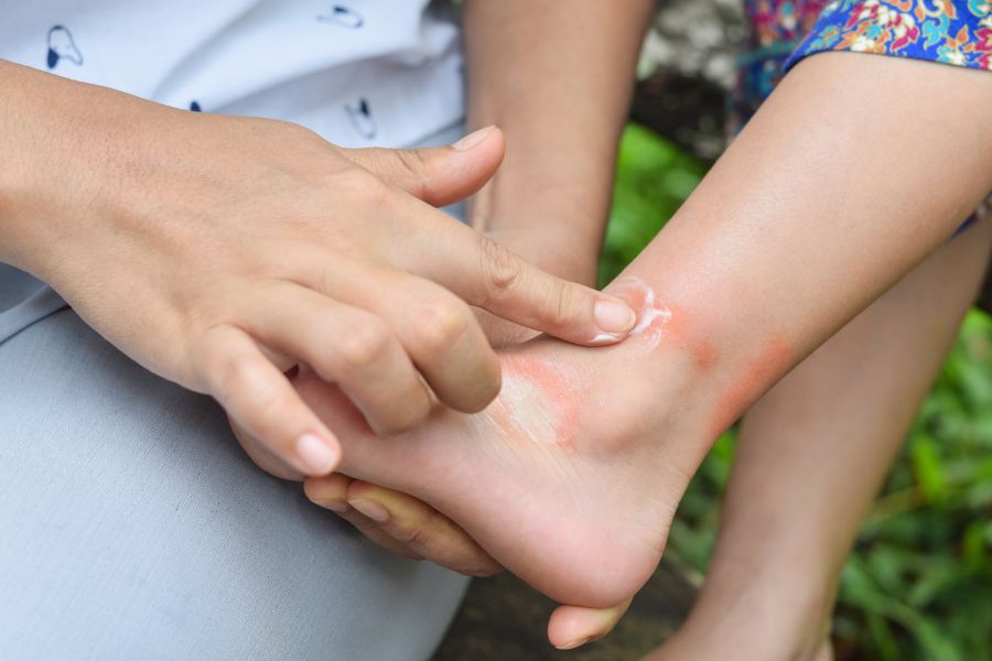 Mom knows how to treat mosquito bites with over-the-counter cream