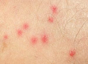 Identifying bed bug bites store on humans