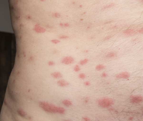 bed bug bites symptoms time