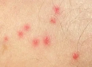 Closeup of bed bug bites on skin | Active Pest Control serving Calhoun, GA