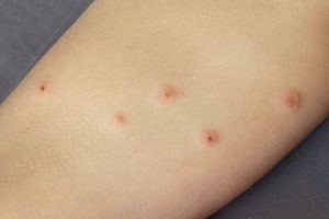 An image of red, scabbed-over bed bug bites on a human arm