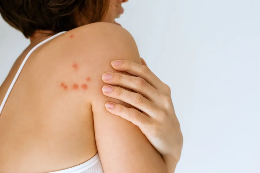 A woman touching a cluster of red, inflamed bed bug bites on her shoulder and upper back.